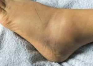 Ai picioarele sau mâinile umflate? Boala gravă care se ascunde în spatele edemului. Când trebuie să mergi la medic!
